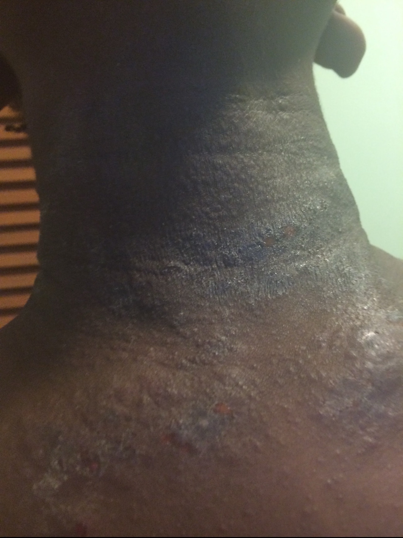 Severe, oozing skin rash on black neck skin of a 11yr old female 